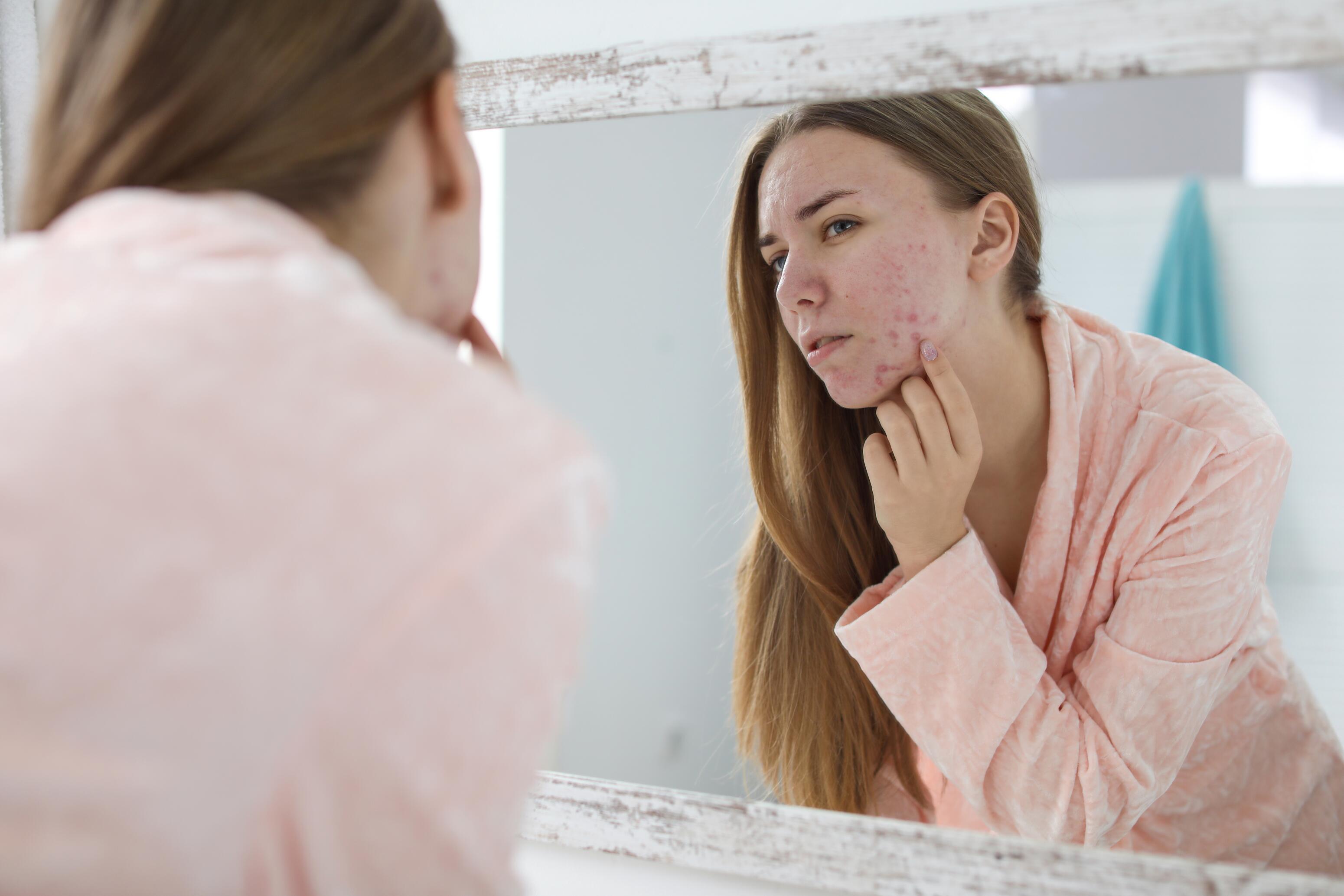 Acné hormonal en adultos